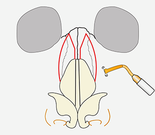 鼻骨骨切り幅寄せ