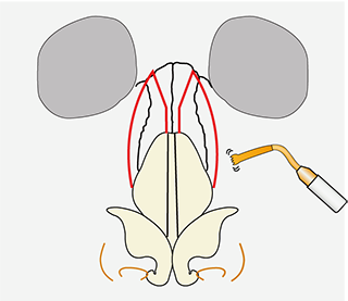 鼻骨骨切り幅寄せ