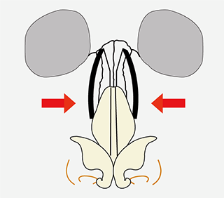 鼻骨骨切り幅寄せ