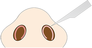 鼻骨骨切り幅寄せ