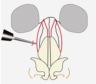 鼻骨骨切り幅寄せ