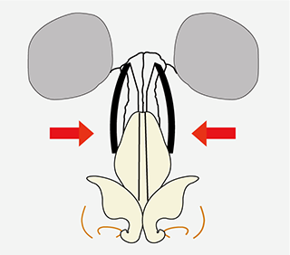 鼻骨骨切り幅寄せ