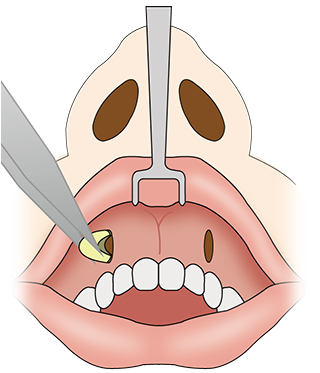 鼻翼基部プロテーゼ