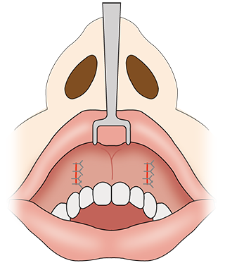 鼻翼基部プロテーゼ
