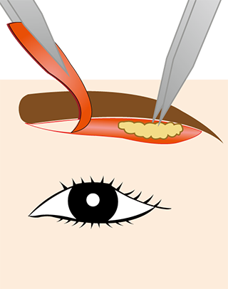 上眼瞼切開（上眼瞼リフト）