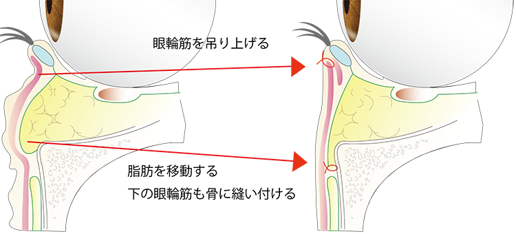 下眼瞼切開術