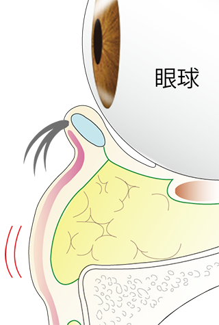 下眼瞼脱脂術