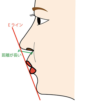 Eラインと鼻翼基部プロテーゼ