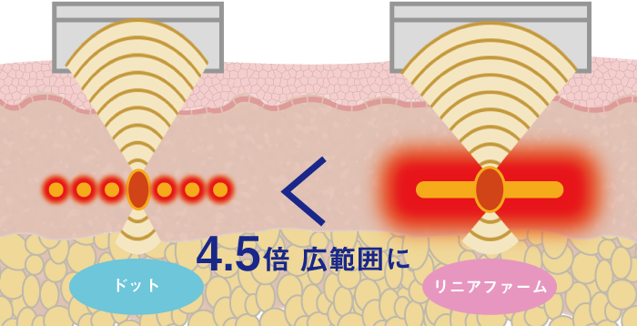 レーザー照射の特徴