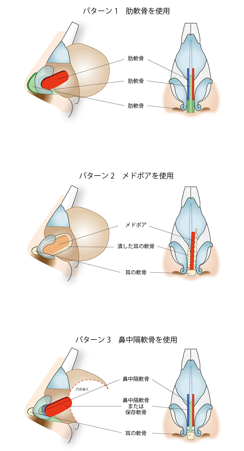 鼻中隔延長術のパターン