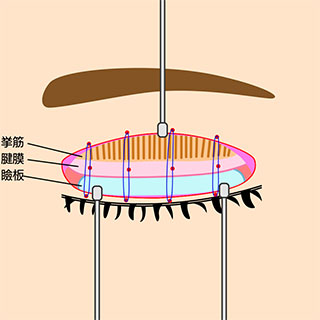 全切開法