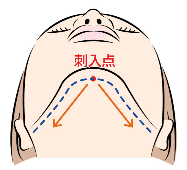 BNLS 3Dメッシュ糸