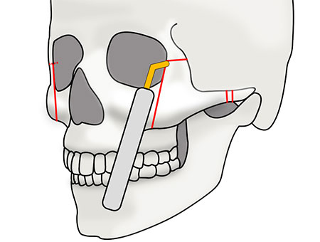 頬骨セットバックの術式