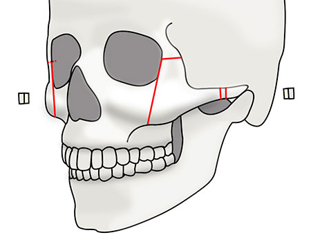 頬骨セットバックの術式
