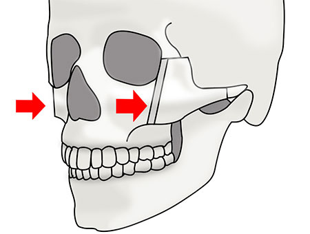 頬骨セットバックの術式