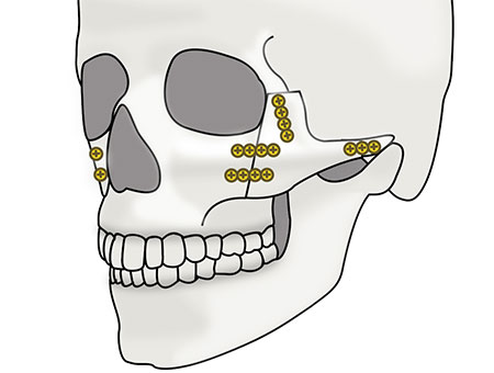 頬骨セットバックの術式