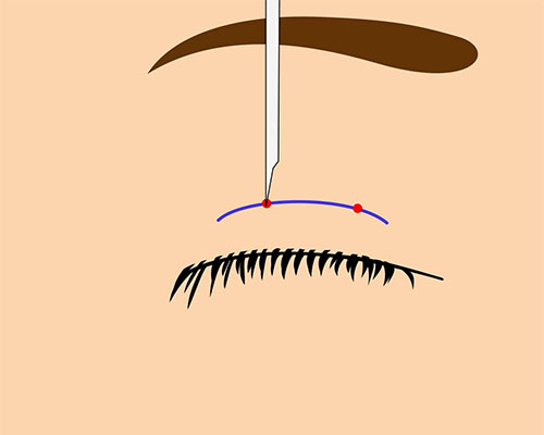 切らない眼瞼下垂