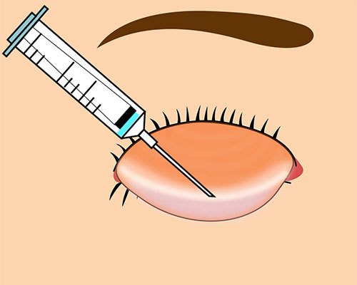 切らない眼瞼下垂