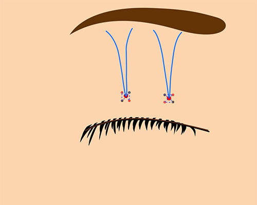 切らない眼瞼下垂